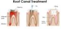 Rootcanal Treatment With Laser