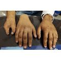 Silicone Hand Prosthesis