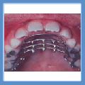 orthodontics brackets